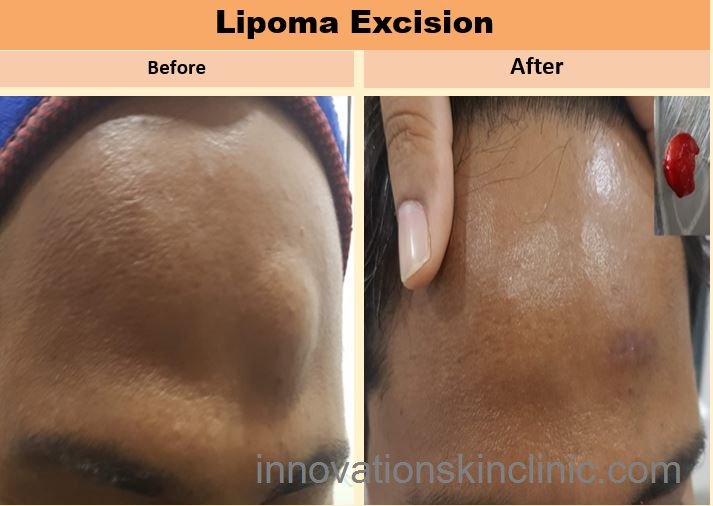 Surgeries For Benign Skin - Lipoma Excision